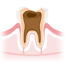 C4：虫歯の末期症状