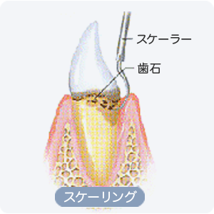 予防歯科　メンテナンス ／スケーリング